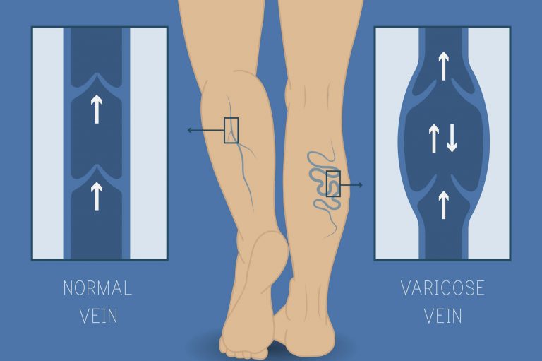 Na imagem, uma perna com as veias em destaque. De uma lado está escrito "normal vein" e do outro "varicose vein".