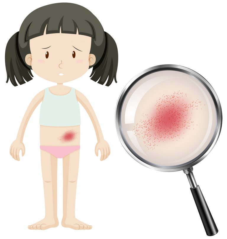 Na imagem, vê-se uma menina com aparência triste e, ao lado dela, uma lupa que evidencia uma mancha vermelha.