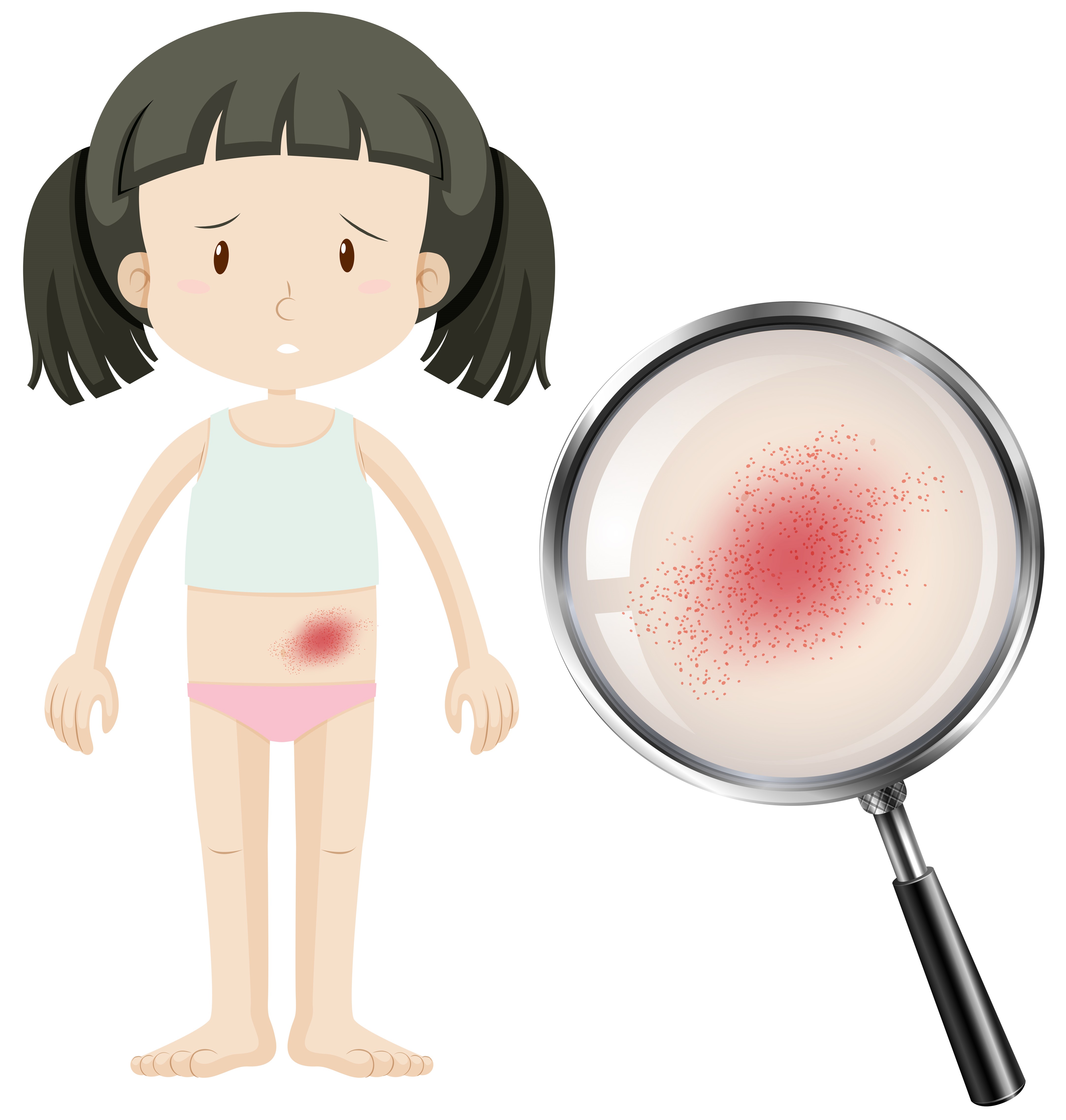 Na imagem, vê-se uma menina com aparência triste e, ao lado dela, uma lupa que evidencia uma mancha vermelha.