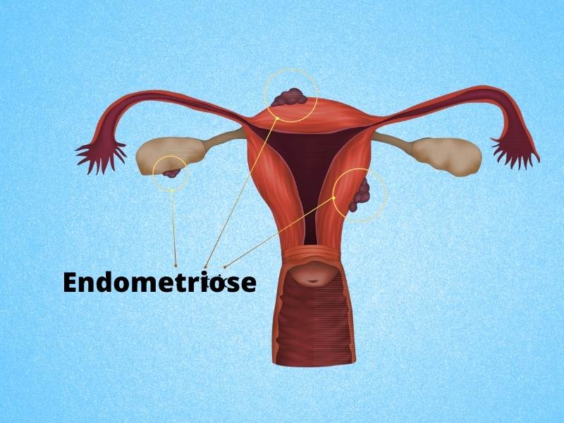 Imagem ilustrativa representando a Endometriose.