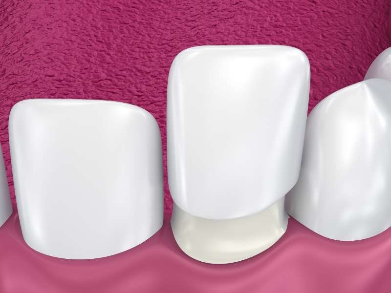 Fixação das facetas de porcelana para melhorar a forma e cor dos dentes.