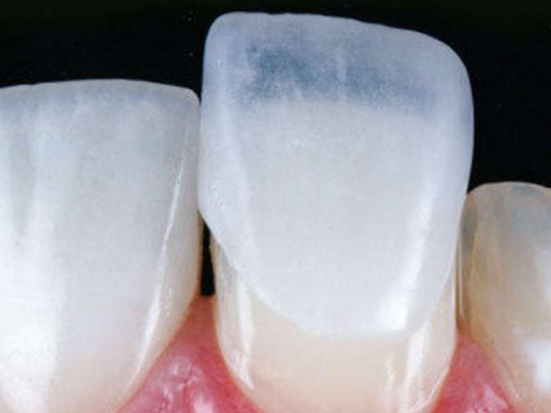 Fixação das lentes de contato dentárias para problemas de oclusão e mastigação.