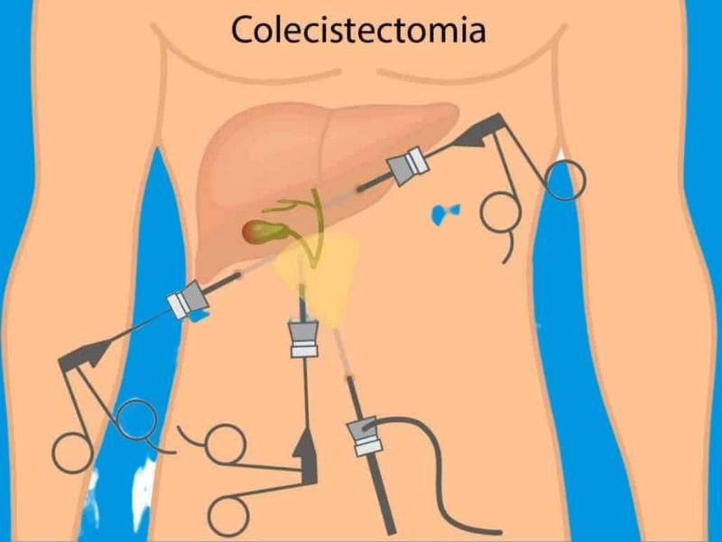 Ilustração de cirurgia para retirar a  vesícula biliar.