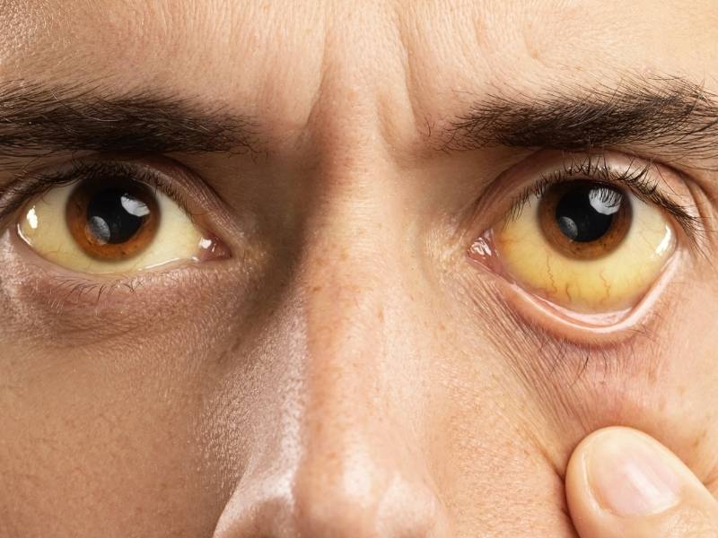 Homem com olhos amarelados.