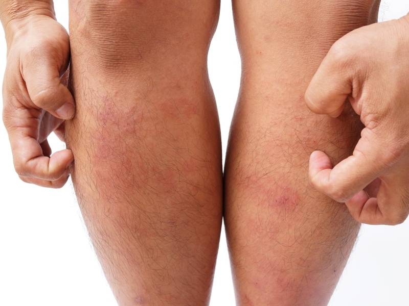 Homem coçando as pernas devido alergia.