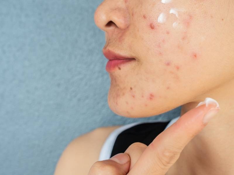 Mulher jovem passando creme nas acnes do rosto.