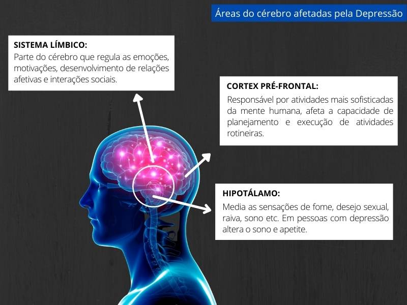 Ilustração de áreas cerebrais afetadas pela depressão.