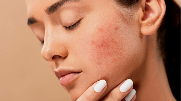 Mulher com a mão no rosto com cicatrizes de acne.
