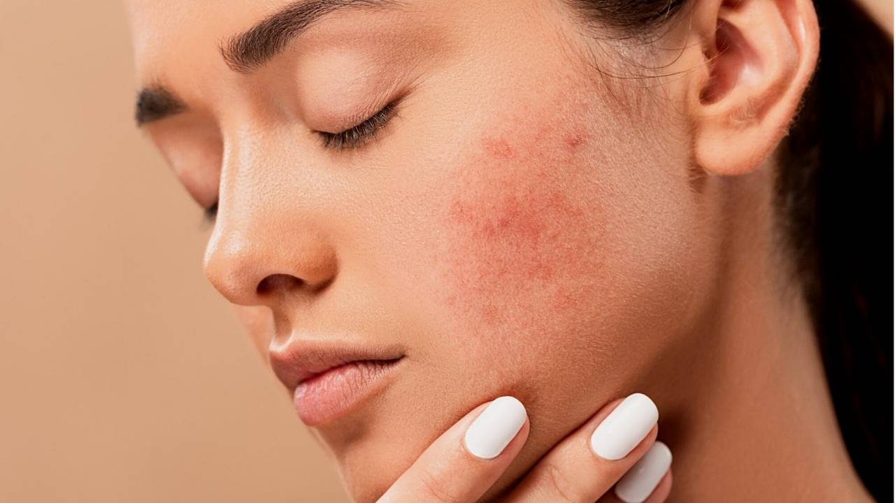 Mulher com a mão no rosto com cicatrizes de acne.