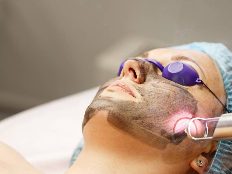 Mulher realizando procedimento para remover cicatrizes de acnes.
