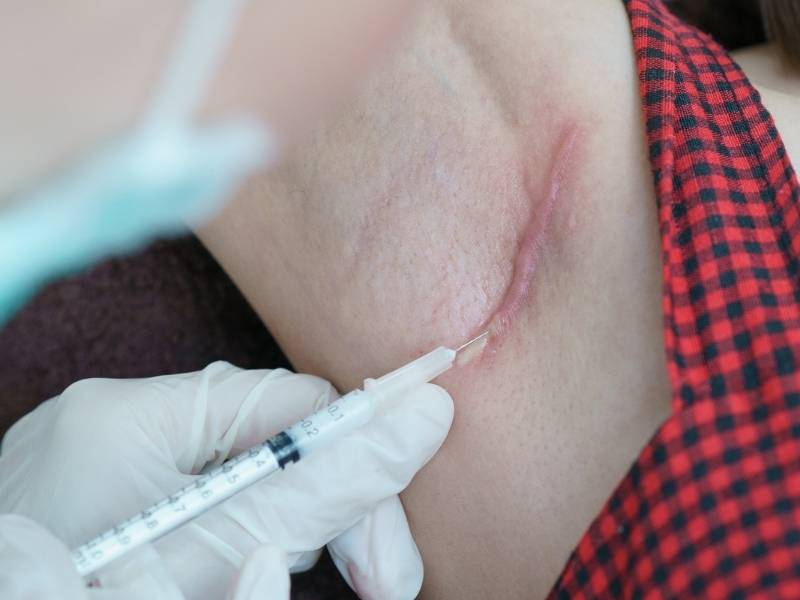 Médica dermatologista fazendo tratamento em queloide na axila.