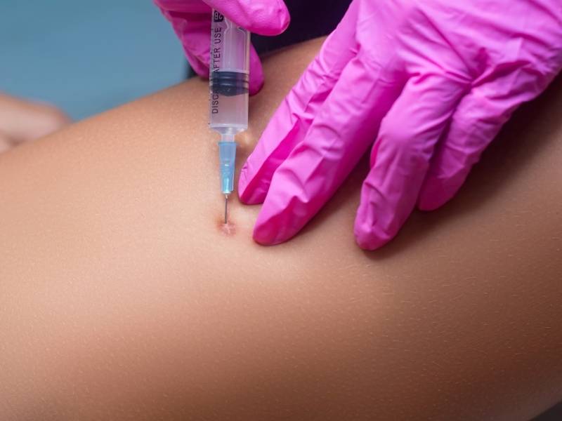 Médico realizando procedimento com agulha para minimizar aspecto de queloide.
