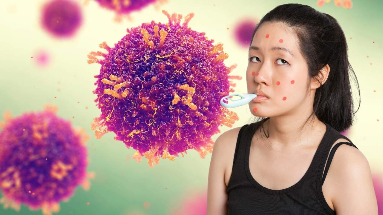 Imagem ilustrativa de virus do sarampo e menina doente com o sarampo.
