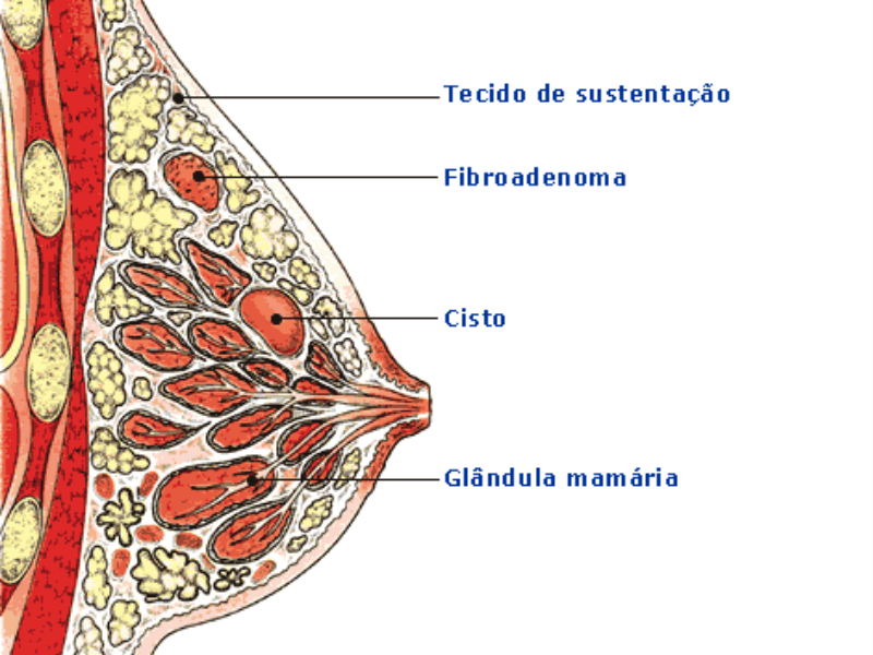 Ilustração de diferença entre glândulas mamarias e cistos ou nódulos.