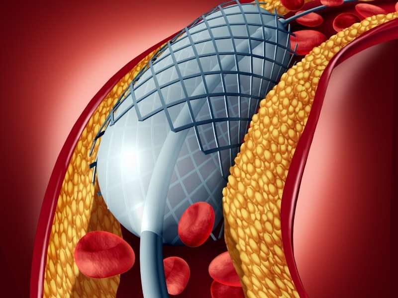 Ilustração angioplastia e cateterismo