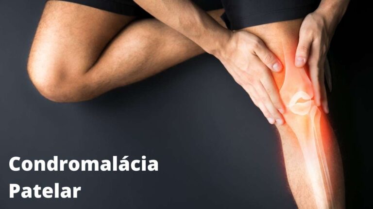 Condromalácia Patear: O que é, causas, sintomas, diagnóstico e tratamento.