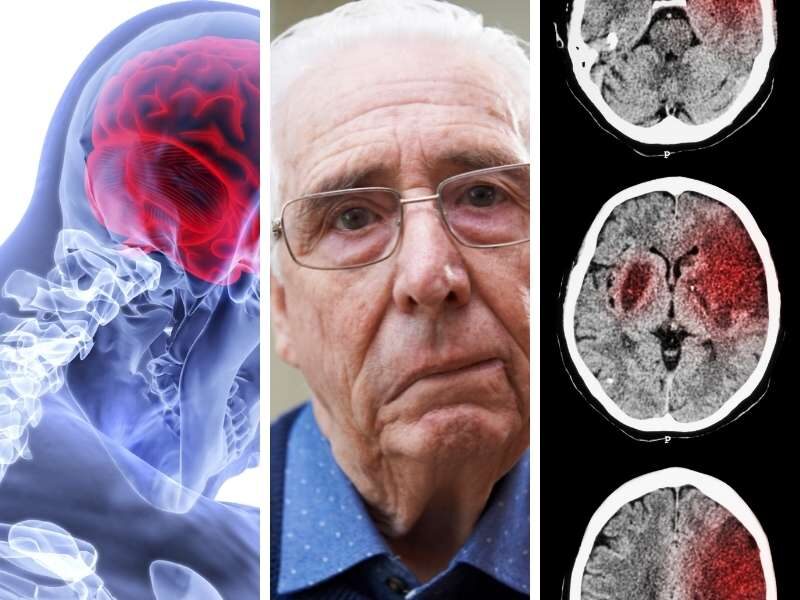 Ilustrações de avc acidente vascular cerebral.