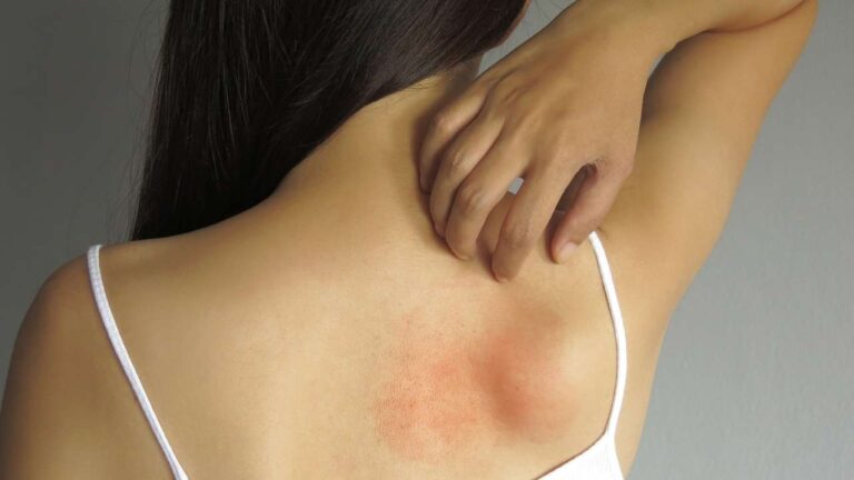 Mulher adulta com assadura nas costas.