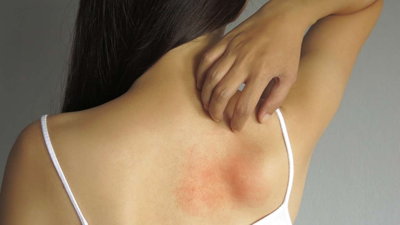 Mulher adulta com assadura nas costas.