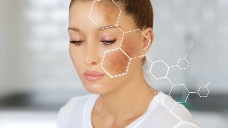 Mulher jovem com mancha devido a melasma.