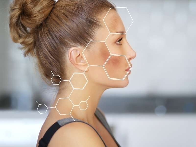 Mulher com melasma.
