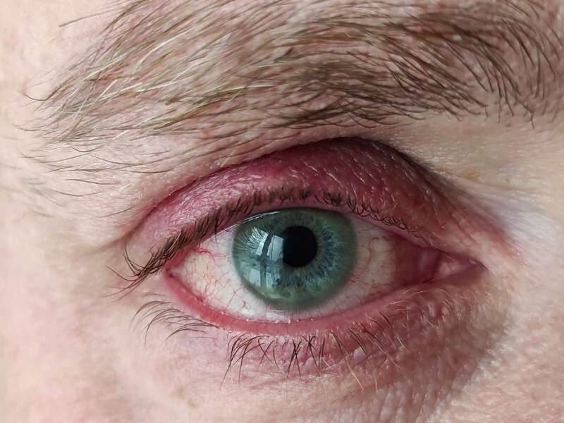 Pessoa com Blefarite e ardência nos olhos.