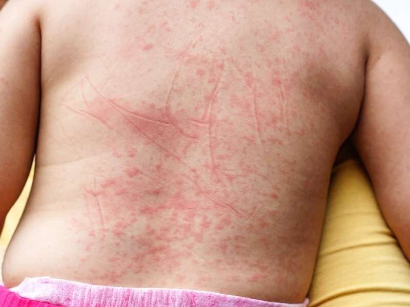 Pacientes com manchas vermelhas no corpo.