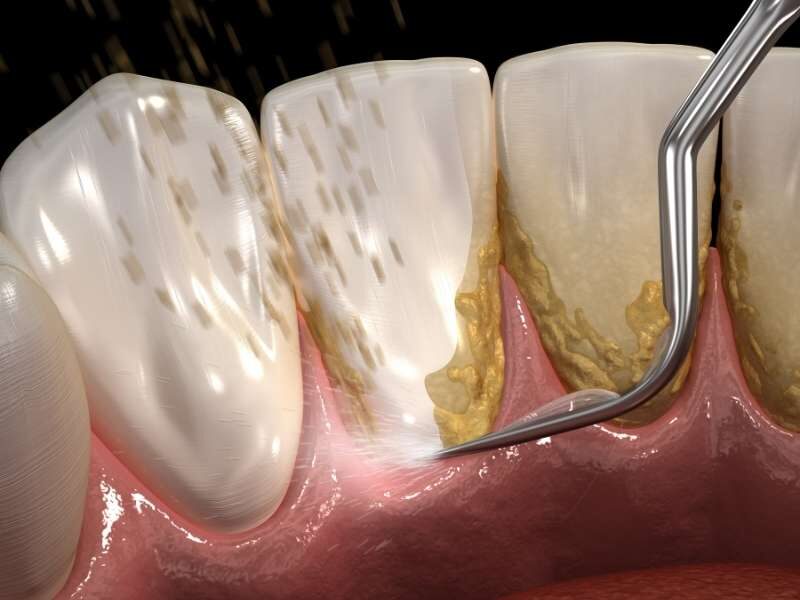 Placa bacteriana nos dentes.