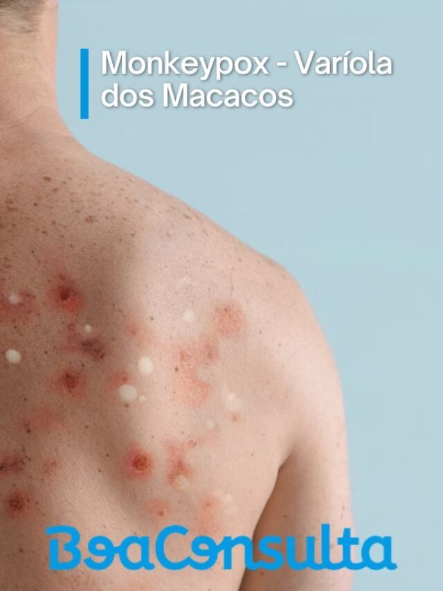 Varíola dos macacos: o que é, sintomas, transmissão, diagnostico e tratamento