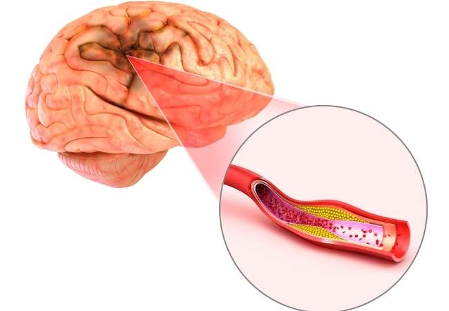 Demência vascular