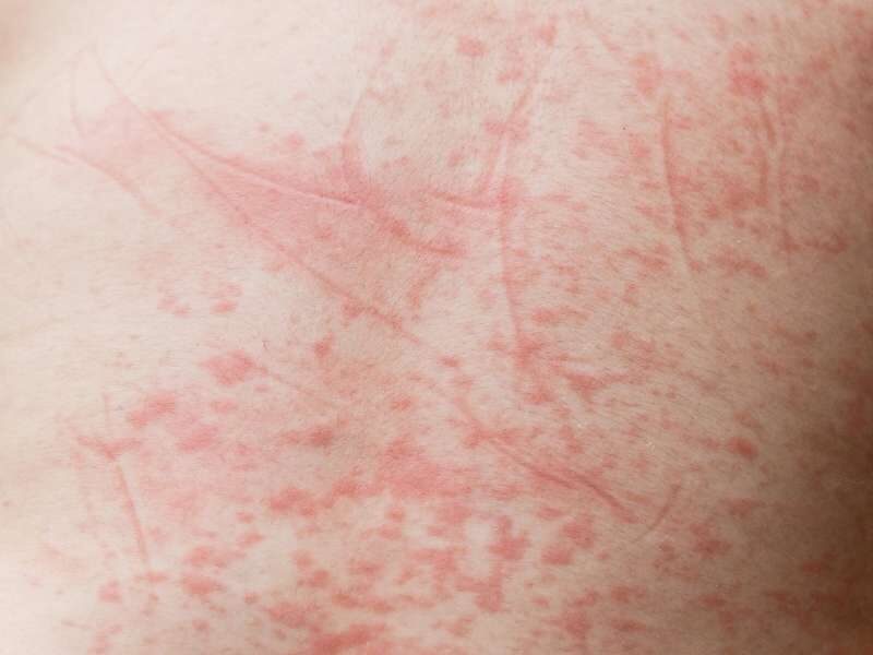 Dengue hemorrágica.