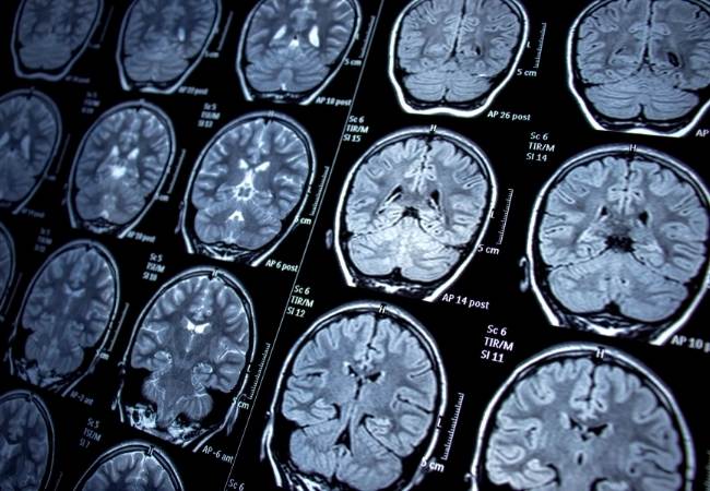 Como diagnosticar o Alzheimer?