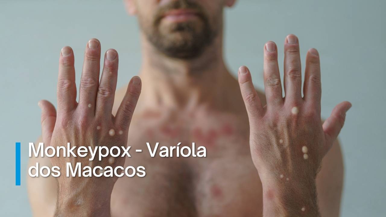 Varíola dos Macacos, vírus Monkeypox.