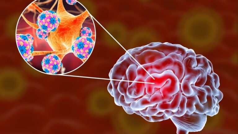 Ilustração meningite e infecção nas meninges.