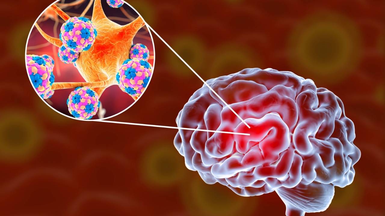 Ilustração meningite e infecção nas meninges.