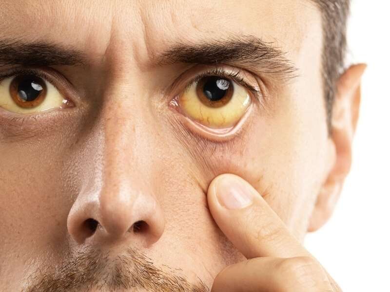 Homem com icterícia (pele e olhos amarelados) devido a hepatite.