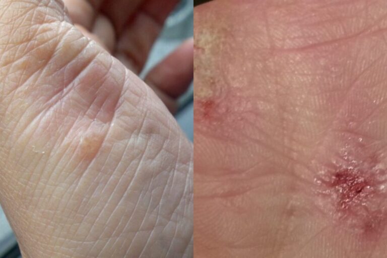 diferença entre dermatite e psoríase
