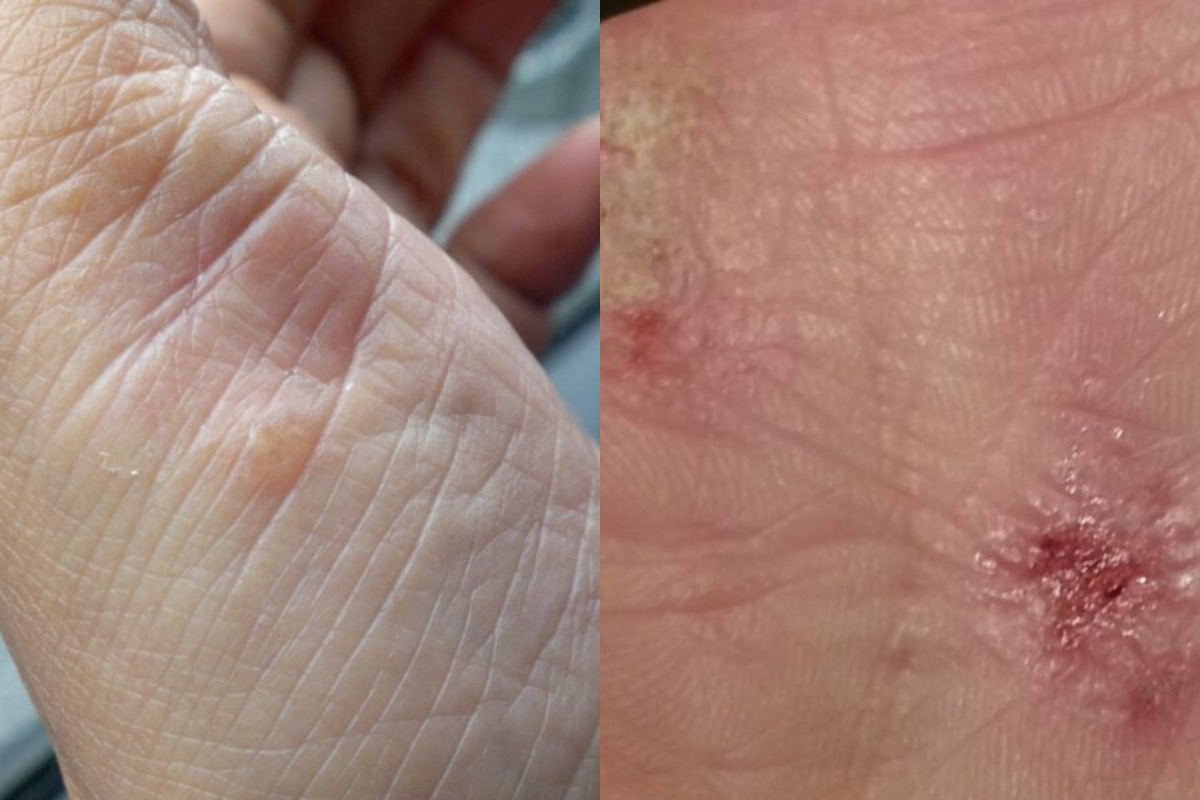 diferença entre dermatite e psoríase