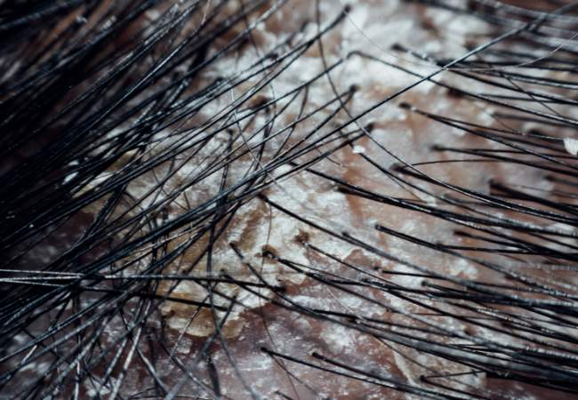 Diferença entre Psoríase e Dermatite Seborreica