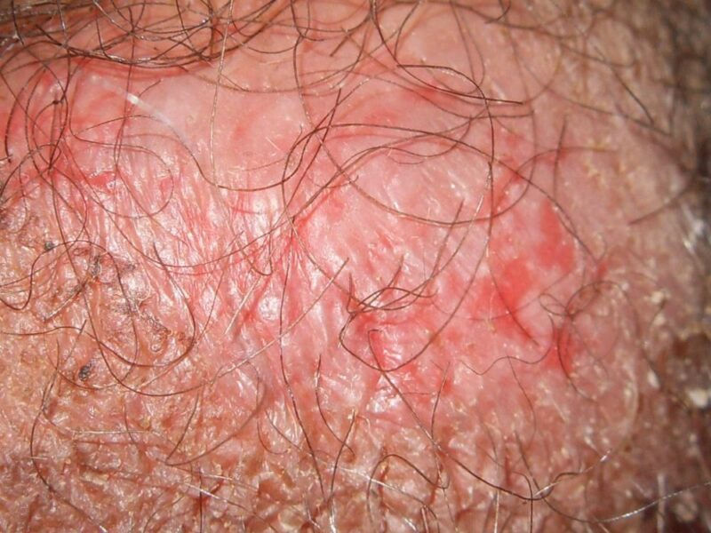 psoríase invertida