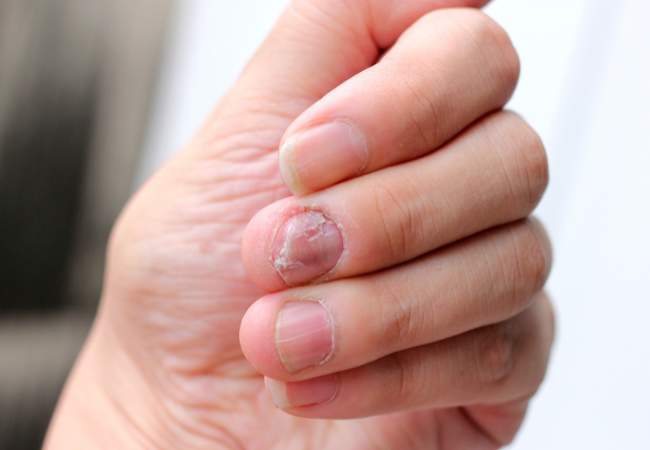 Unhas grossas e descoladas é sintoma de psoríase
