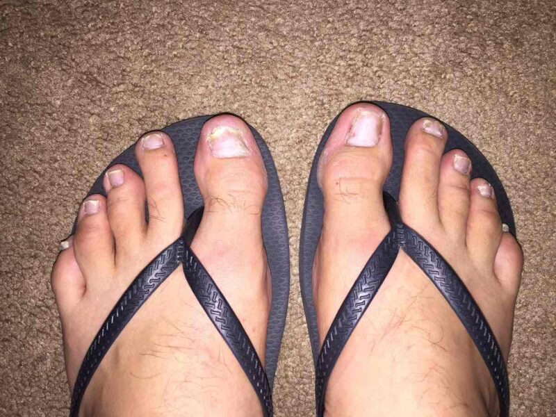 psoríase nas unhas