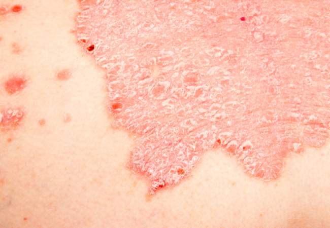 Existe prevenção da psoríase?