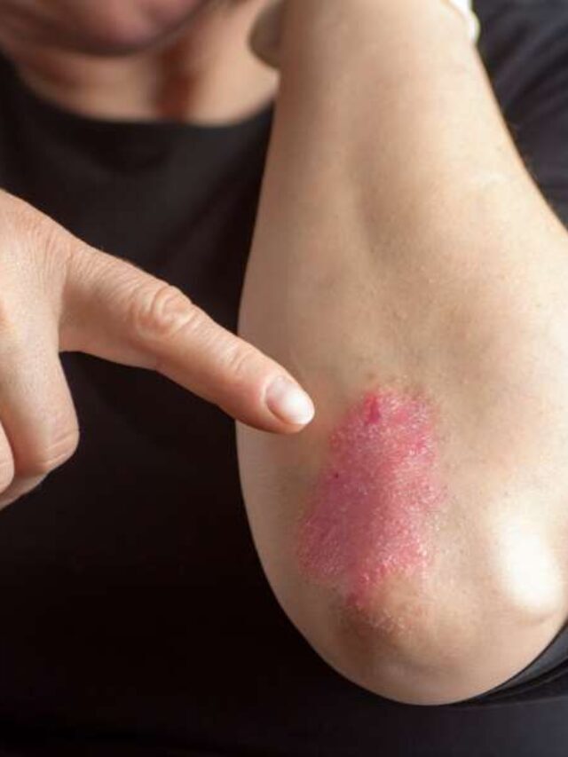 10 Sintomas de psoríase para se preocupar! – BoaConsulta