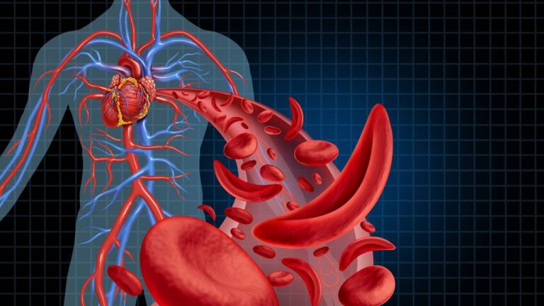 Anemia Falciforme, sintomas, causas, tratamento.