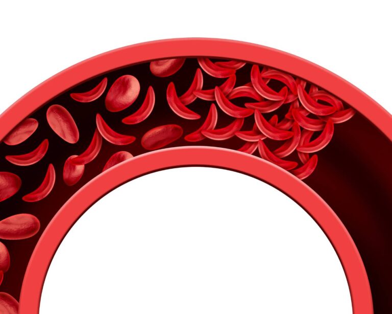 Entenda o porque a anemia falciforme não tem cura