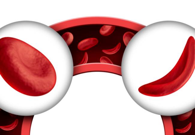 Anemia falciforme não é transmissível