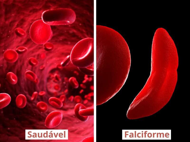 Comparativo de glóbulos vermelhos saudáveis e com anemia falciforme.
