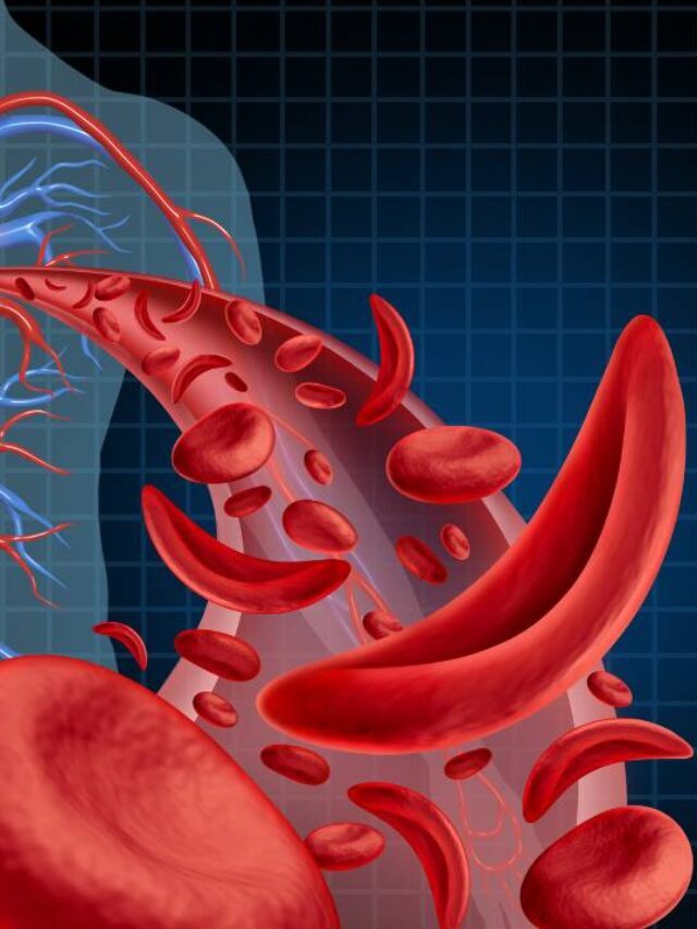 Anemia falciforme: o que é, sintomas, causas e tratamento – BoaConsulta