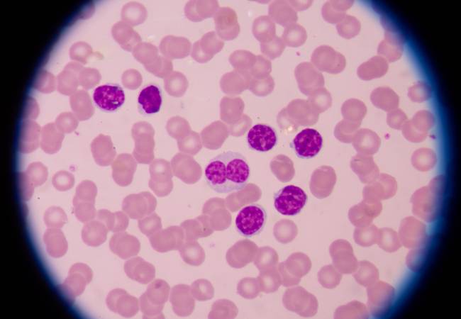 A leucemia tem um aspecto clinico totalmente diferente da anemia falciforme